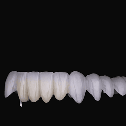 Temporary bridge offers short-term replacement to restore function and appearance while finals set